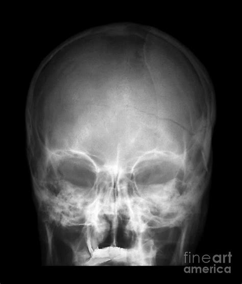 Fractured Skull X Ray Photograph By Zephyr Pixels