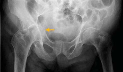 Acetabular Fracture And Protrusio Acetabuli In An Elderly Patient