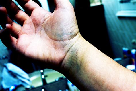 All it takes is a momentary loss of balance. sprained wrist | Flickr - Photo Sharing!