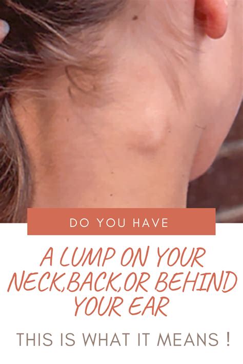 Do You Have A Lump On Your Neck Back Or Behind Your Ear This Is What It