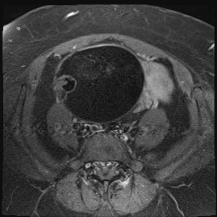 Ovarian Mature Cystic Teratoma Image Radiopaedia Org