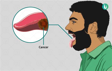 Tongue Cancer Symptoms Causes Treatment Medicine Prevention