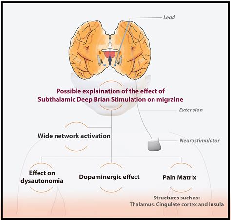 Case Report Migraine Resolution Post Bilateral Subthalamic Deep Brain Stimulation Ahmed