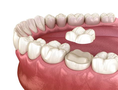 根管治療牙套種類有哪些？4種牙套優缺點、價格與案例分享 京鼎牙醫