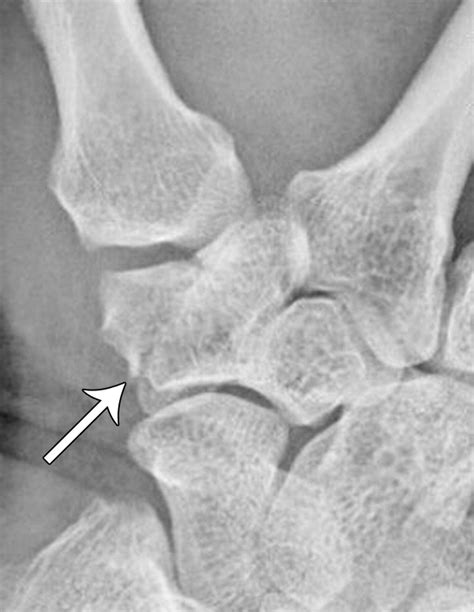Multidetector Ct Of Carpal Injuries Anatomy Fractures And Fracture