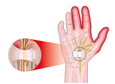 Carpal Tunnel Syndrome Raleigh Hand Surgery — Joseph J Schreiber Md