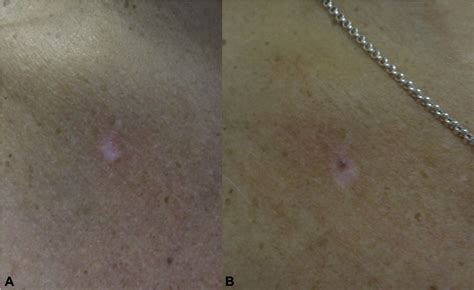 Two Reports Of Malignant Melanoma Arising Within A New Vitiligo Like