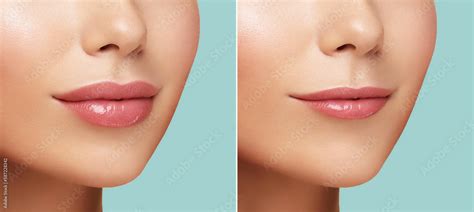 Comparison Of Womens Lips Filler Correction Before And After