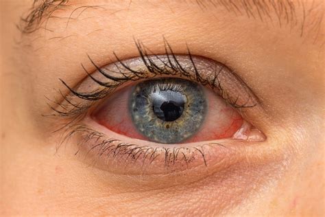5 Most Common Causes Of Itchy Eyes And Recommended Treatment • Page 6
