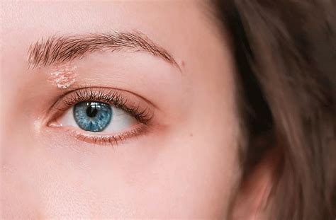 Dry Eyelids Causes And Remedies According To 59 Off
