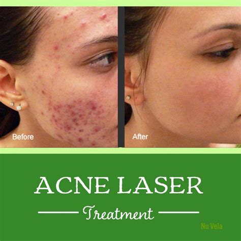 Acne Laser Treatment Los Angeles Blue Light Acne Removal