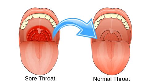 Antibiotics don't work on viruses. Sore Throat Treatment in Ayurveda I Symptom & Causes ...