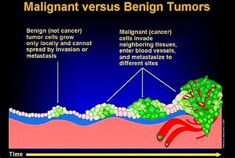 Benigni Benign Vs Malignant Tumors