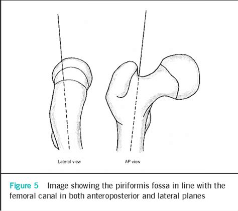 Figure From Piriformis Fossa Approach In Optimising Femoral Neck Hot Sex Picture