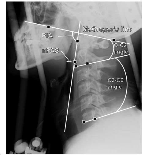 Representative Lateral Plain X Rays Of The Cervical Spine O C2 Angle