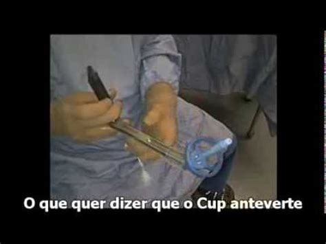 Histerectomia laparoscópica total no contexto clínico Parte I YouTube