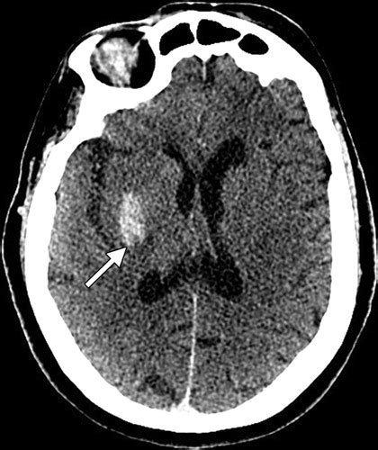 Evaluation Of Dual Energy Ct For Differentiating Intracerebral