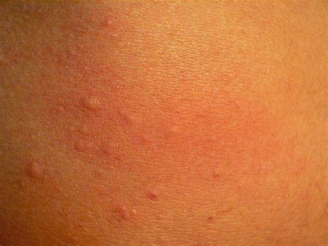 It may appear on one part of the body or be spread across large areas. Cholinergic Urticaria - Causes, Picture, Symptoms And Treatment