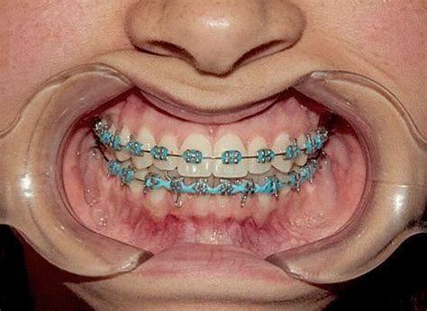 Pin De John Beeson En Orthodontic Braces Brackets Dentales Ligas Para Brackets Brackets