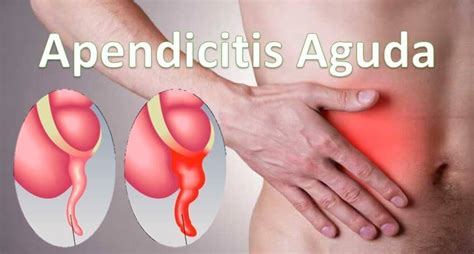 Apendicitis Aguda Etiologia Diagnostico Y Manejo De La Apendicitis