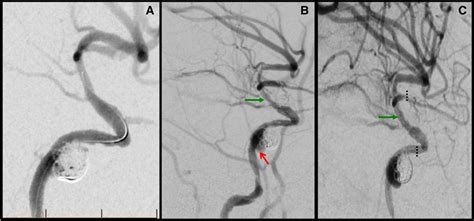 Staged Endovascular Reconstruction Of Complex Traumatic Intracranial