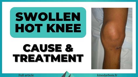 Swollen Hot Knee Why How To Treat Physical Therapy Tips