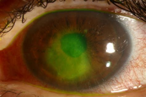 Recurrent Erosion Syndrome QEI Laser Laser Eye Surgery Queensland