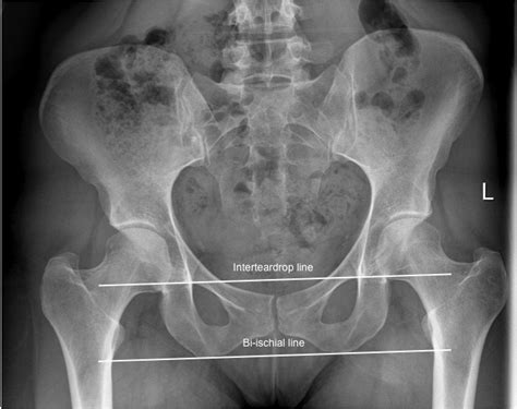 Hip Radiographic Evaluation Adult Recon Orthobullets