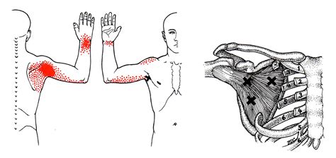 Subscapularis The Trigger Point And Referred Pain Guide