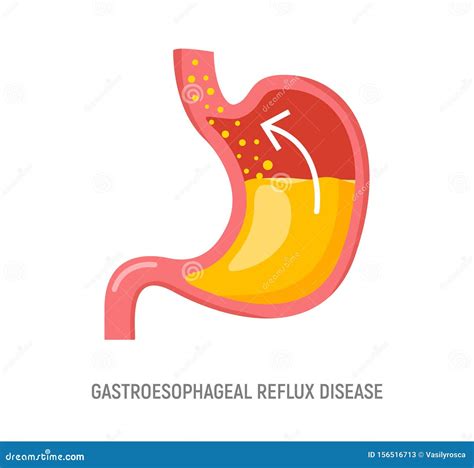 Gastroesophageal Reflux Disease Stomach Gerd Heartburn Esophagus