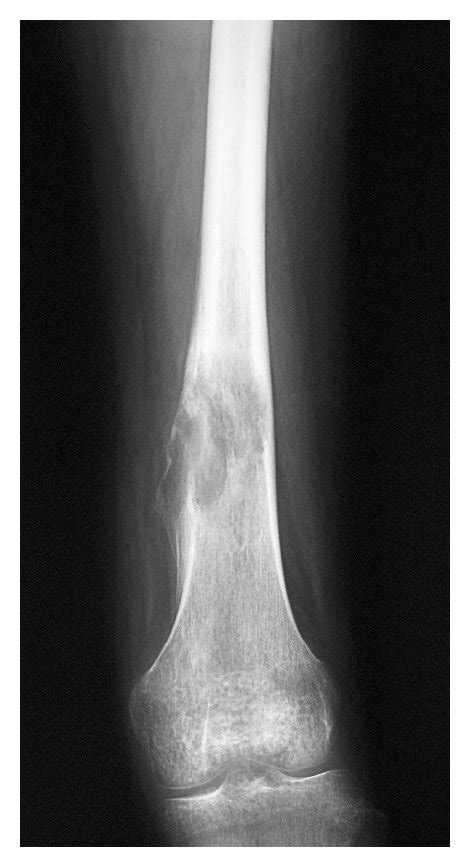 A Plain Radiograph Of The Left Distal Femur Demonstrates An Osteolytic