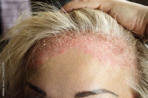 Dermatological Skin Disease Psoriasis Eczema Dermatitis Allergies Skin Lesions On The Head
