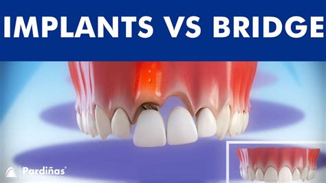 Dental Implants Vs Tooth Bridge Comparison © Youtube