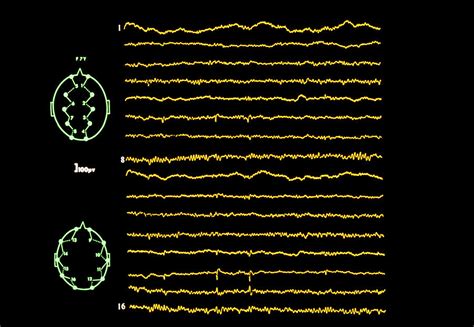 Eeg In Epilepsy Intermittent Focal Spikes Photograph By Science Photo