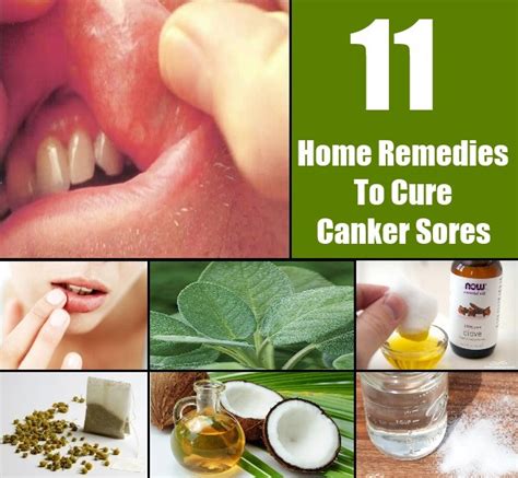 11 Top Home Remedies To Cure Canker Sores Diy Home
