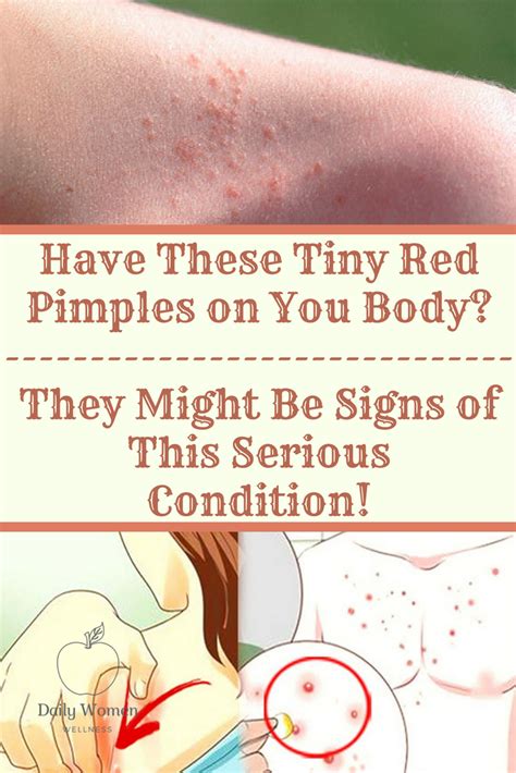 Been Noticing Red Little Pimples Spreading Across Your Body Many Of Us