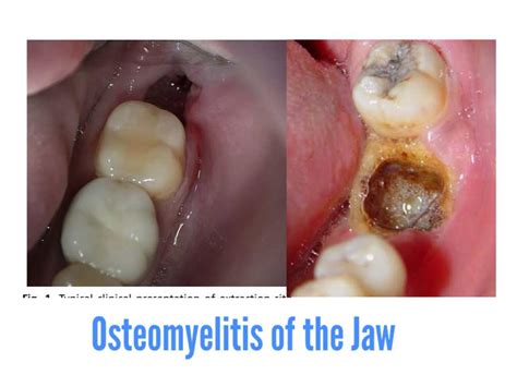 What Is Osteomyelitis And How Does It Enter The Bone