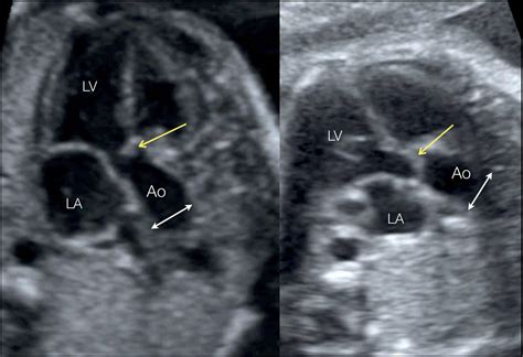 Aortic Stenosis Ultrasound