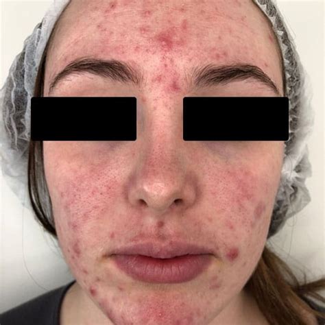 Acne Facial Treatment For Adults And Teens In Scottsdale