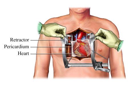 There is no special or preferred aerobic exercise for heart valve surgery, but to answer this, i how do you know which one is right for you after surgery? Heart valve surgery. Causes, symptoms, treatment Heart ...