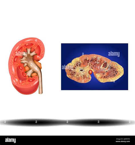 Kidney Internal Organ Kidney Stones Renal Calculi Nephrolithiasis
