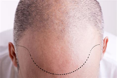 Hair Transplant All About Side Effects Twinkle Thomas Magazine