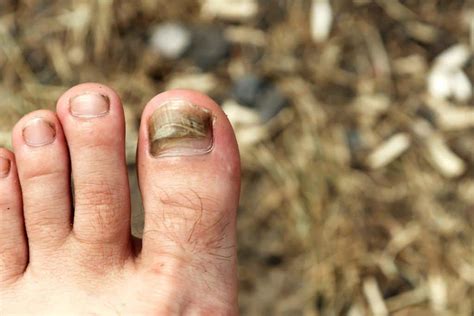 Black Toenail Find Out More About Your Black Toenail Today