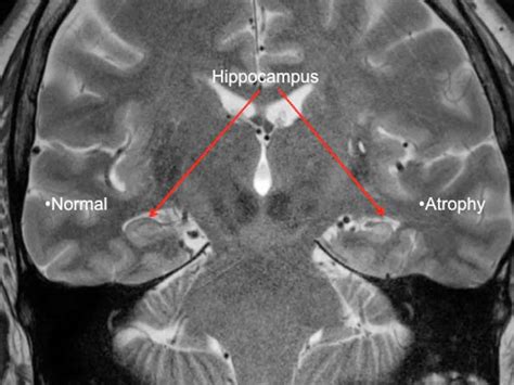 Temporal Lobe Epilepsy Causes Symptoms Diagnosis Treatment And Prognosis