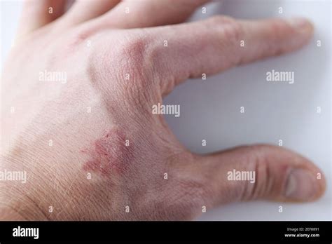 Rash Protection Hi Res Stock Photography And Images Alamy