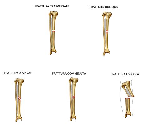 Frattura della Tibia