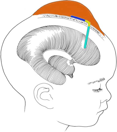 Schematic Drawing Of A Child With A Vsg Note The Hydrocephalus