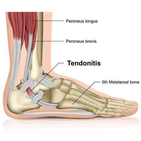 Peroneal Tendonitis Causes Symptoms And Treatment · Dunbar Medical