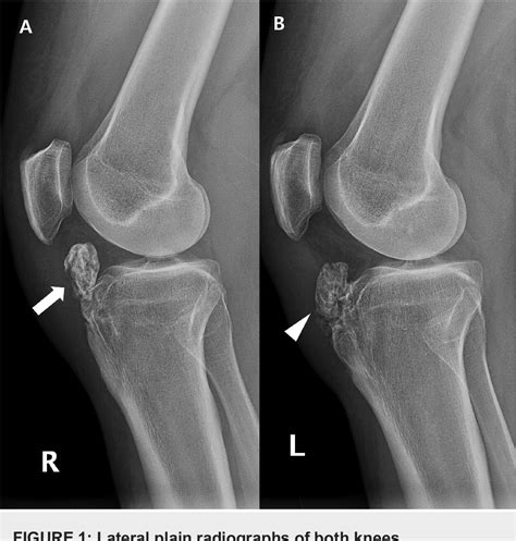 Figure 3 From Intra Articular Large Ossicle Associated To Osgood