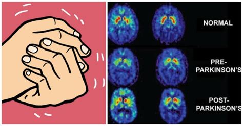La stimolazione cerebrale profonda può rallentare la progressione del tremore nel Parkinson